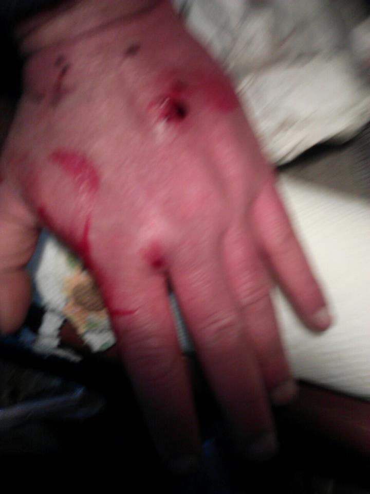 Exhibit A: My hand after one week of breaking up violent assaults instigated by the mutt, Lamont on other mutts
